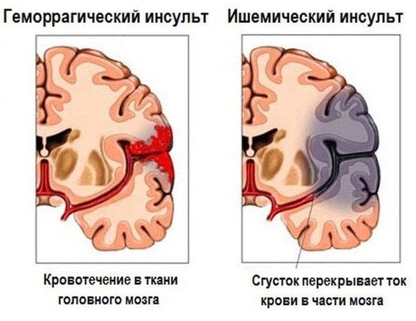 Инсульт – это острое нарушение мозгового кровообращения, приводящее к отмиранию клеток головного мозга.