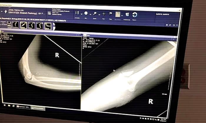 На рентгеновском снимке видны обломки костей и части пули в локтевом сгибе Ханны.